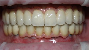 الصورة: استعادة الأسنان كاملة