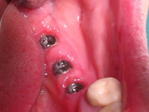 Foto: A condição da mucosa no pós-operatório