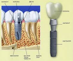 Foto: Structura implantului