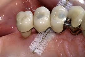 Снимка: Грижа за зъбни импланти
