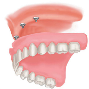 الصورة: تثبيت أسنان قابلة للإزالة في الفك العلوي باستخدام عمليات زرع صغيرة
