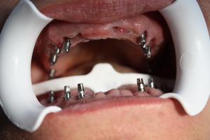 Nuotrauka: bazinis implantavimas, kai visiškai nėra dantų