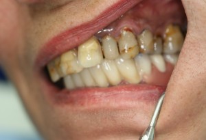 Foto: Het effect van roken op de tand- en mondgezondheid