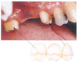 Photo: Turning adjacent teeth when installing a bridge