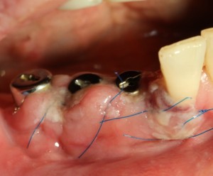 Foto: edema en el área de implantes instalados