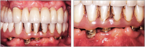 Foto: Plaque auf Implantaten und künstlichen Zähnen