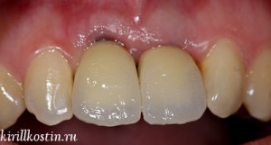 Foto: respingerea implantului dinților