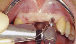 Foto: Implantação endoscópica