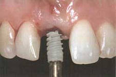 Foto: plasarea implantului după extracția dinților