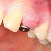Foto: Hyperemie en zwelling van het tandvlees
