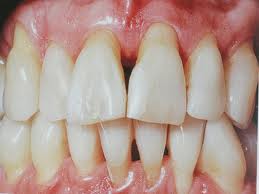 Fotografie: periodontálna choroba