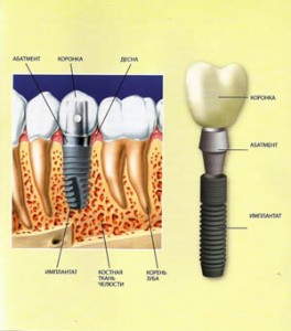 Foto: Structura implantului