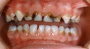 Снимка: Гниене на гниене на широколистни зъби