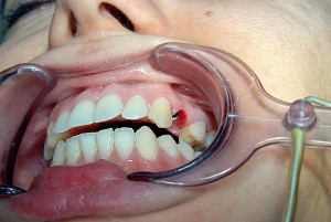 Foto: Implantation omedelbart efter tanduttag