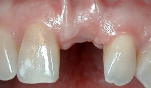 Foto: afwezigheid van een voorste tand in de bovenkaak - indicatie voor implantatie