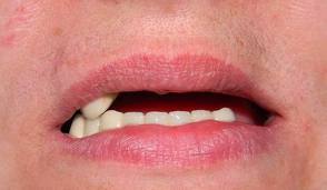 الصورة: غياب جزئي للأسنان ، إشارة إلى تركيب الأطراف الاصطناعية.