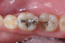 Foto: Prótesis de dientes de leche con pestañas dentales.