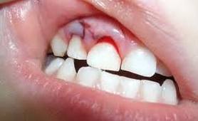 FOTO: Lesão dentária