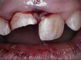 Foto: lesión dental