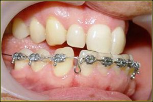 Foto: correcció de la dentició de la mandíbula inferior