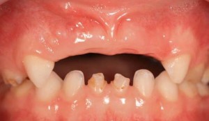 Photo: Lack of frontal primary teeth