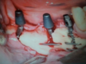 Foto: Geïnstalleerde BOI-implantaten in de onderkaak