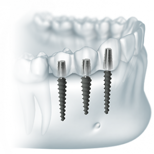 Foto: Implantate, die durch eine Zahnfleischpunktion eingeführt wurden