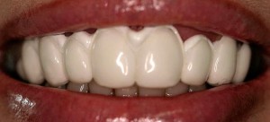 Foto: Emailrestauratie door remineralisatie van tanden