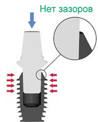 Foto: Conexão do implante com o pilar