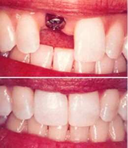 Kuva: Implantin ja luonnollisen hampaan samankaltaisuus