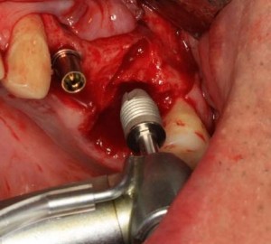 Foto: Inserção de um implante em um orifício após extração dentária
