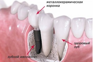 Foto: implant dentar instalat