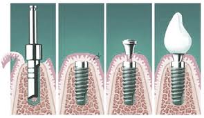 Foto: Stadia van klassieke implantatie