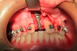 Photo: Installation de l'implant BOI