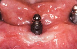 Falto: ontsteking van het tandvlees rond het implantaat