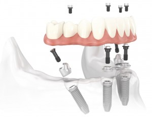 Foto: Implantación con implantes Nobel