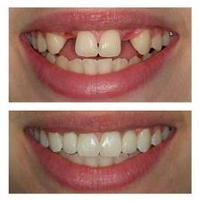 Foto: voor en na tandheelkundige implantaten