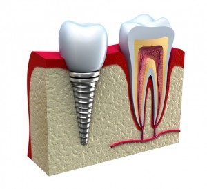 Foto: tandheelkundig implantaat in plaats van ontbrekende tand