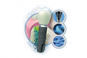 Foto: Astra Tech Implant