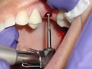 Foto: Implantatie implantatie procedure