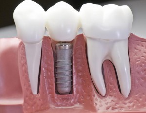 Foto: implante dental en forma de raíz