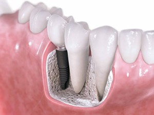 Kuva: Dental Implant