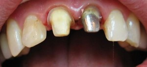 Photo: Teeth prepared for fixing cermets