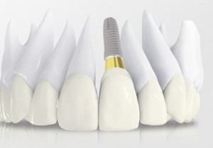 Foto: Implantácia dentínu