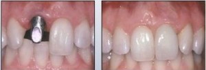 Foto: implantació abans i després