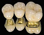 Foto: Keramiska metallkronor på en guldram för att tugga tänder