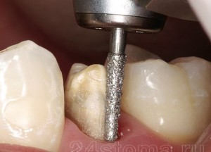 Fotoğraf: Bir taç altında diş taşlama