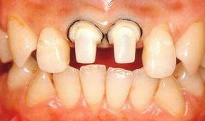الصورة: تحول الأسنان مع الحافة
