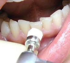 الصورة: تنظيف الأسنان من البلاك قبل تثبيت القشرة