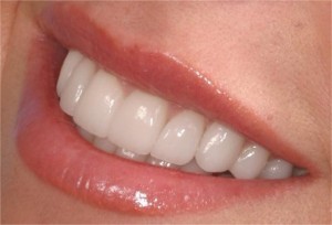 Nuotrauka: keramikiniai priekiniai dantys